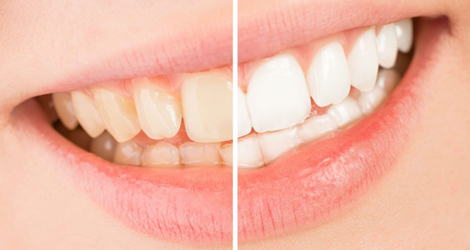 Tooth whitening