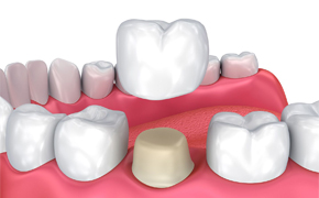  Metalfree Crowns & Bridges