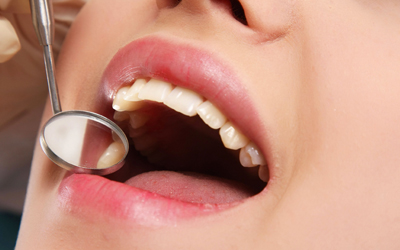 Gum Disease: Types, Symptoms & Solutions